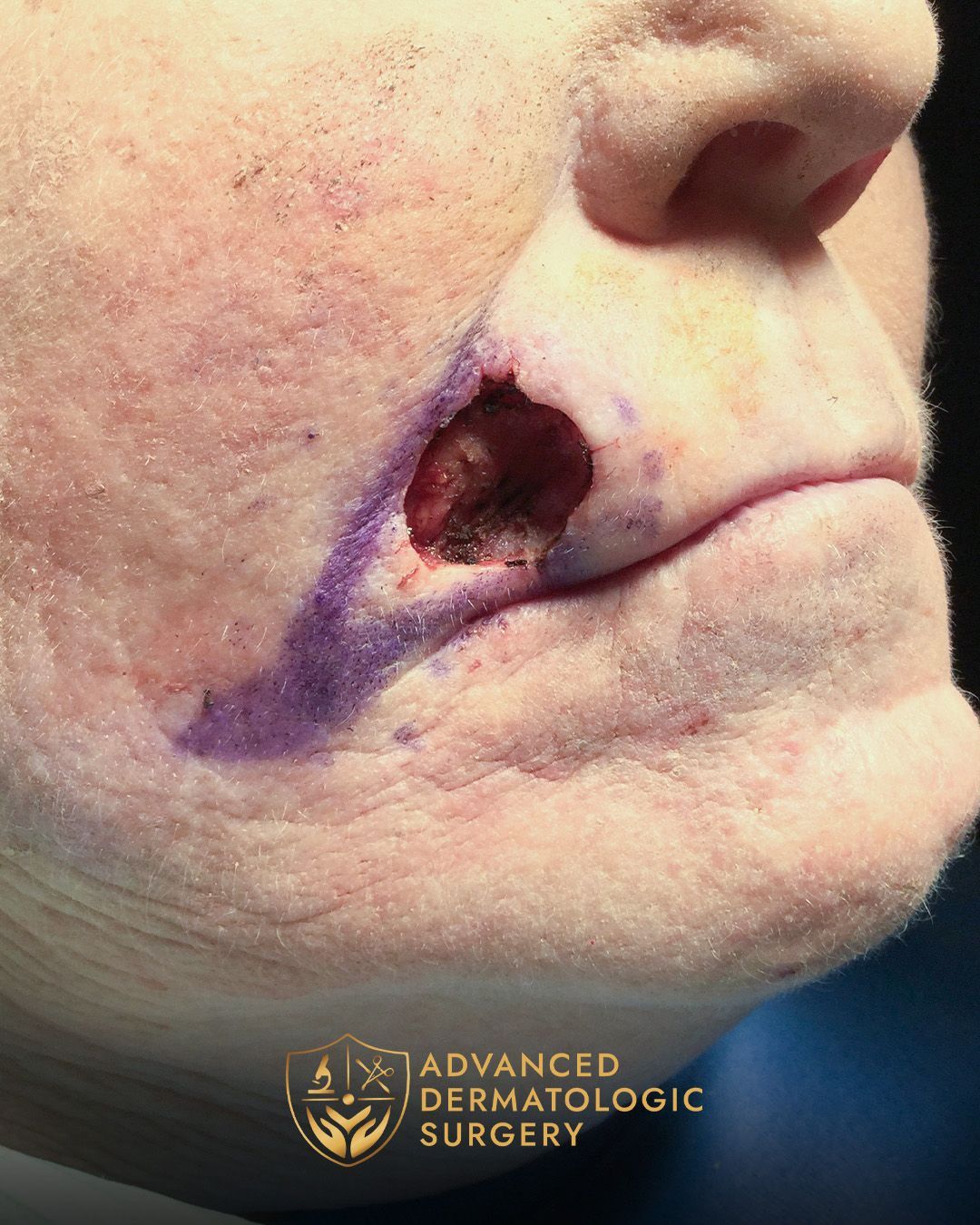 Close up of a woman's cheek after Mohs surgery