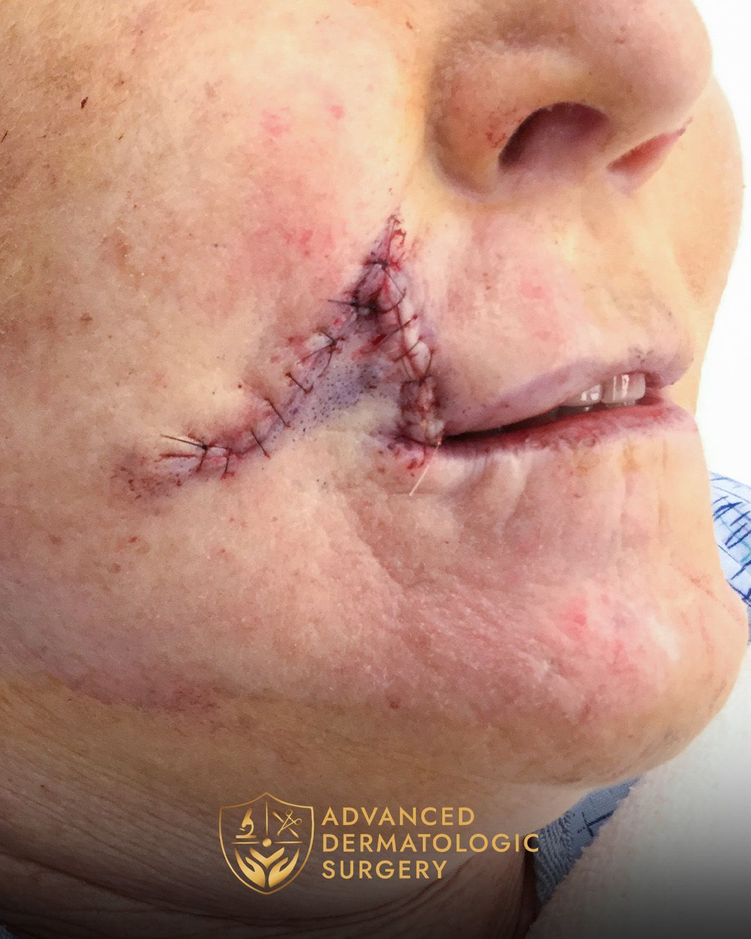 Close up of a woman's cheek after reconstruction surgery
