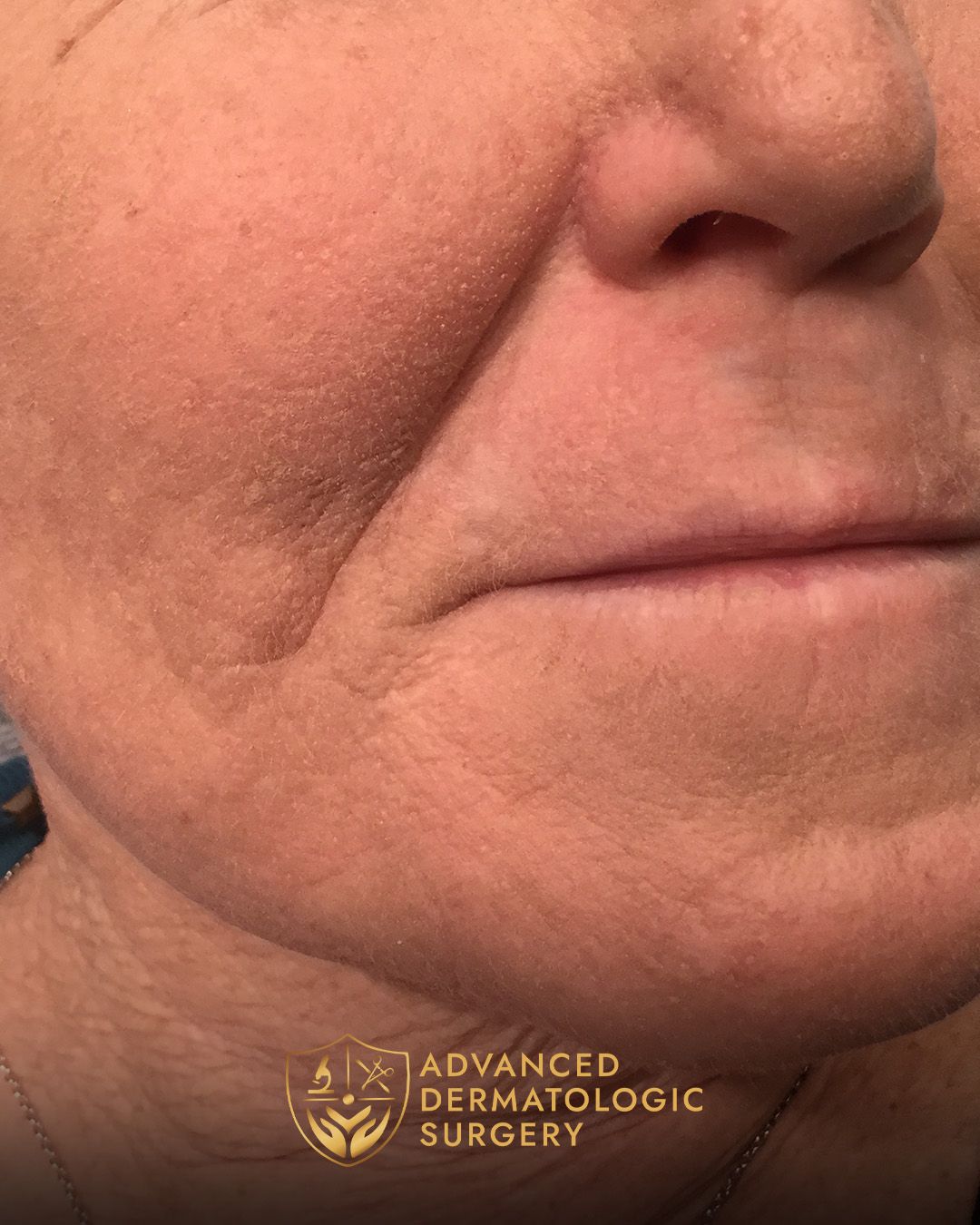 Fully healed cheek close up