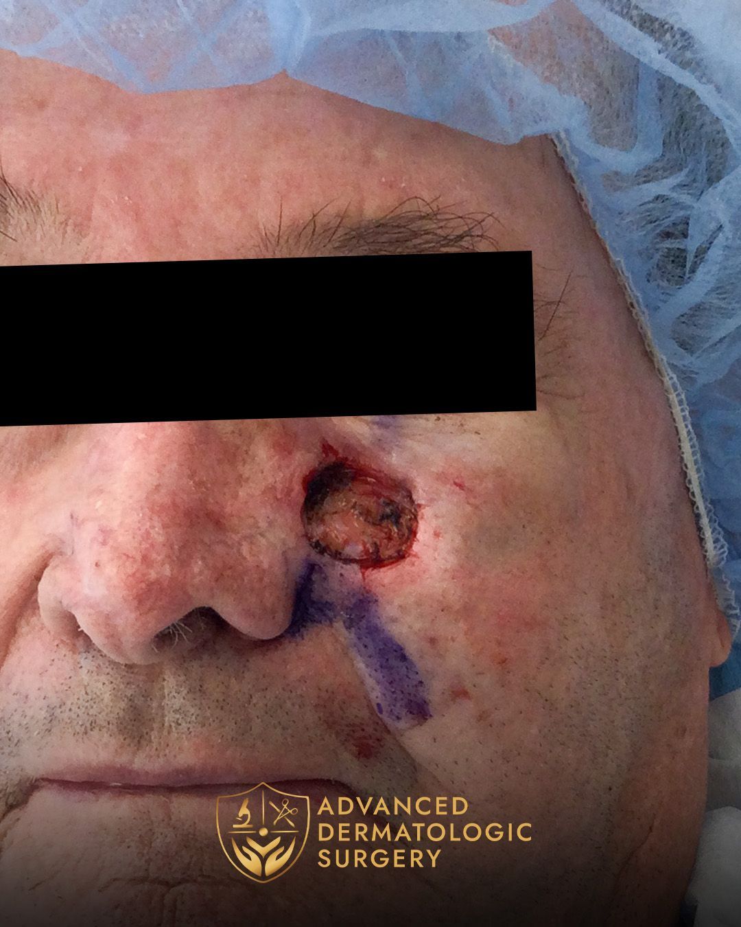 Close up of a man's cheek after Mohs surgery