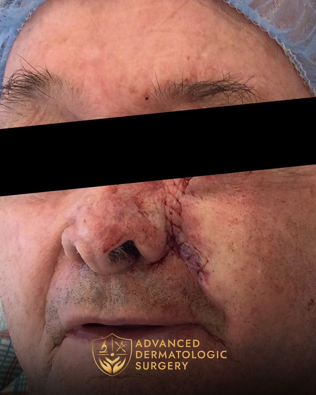 Close up of a man's cheek after reconstruction surgery