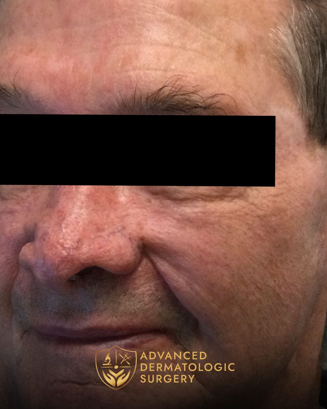 Close up of a man's cheek with fully healed results