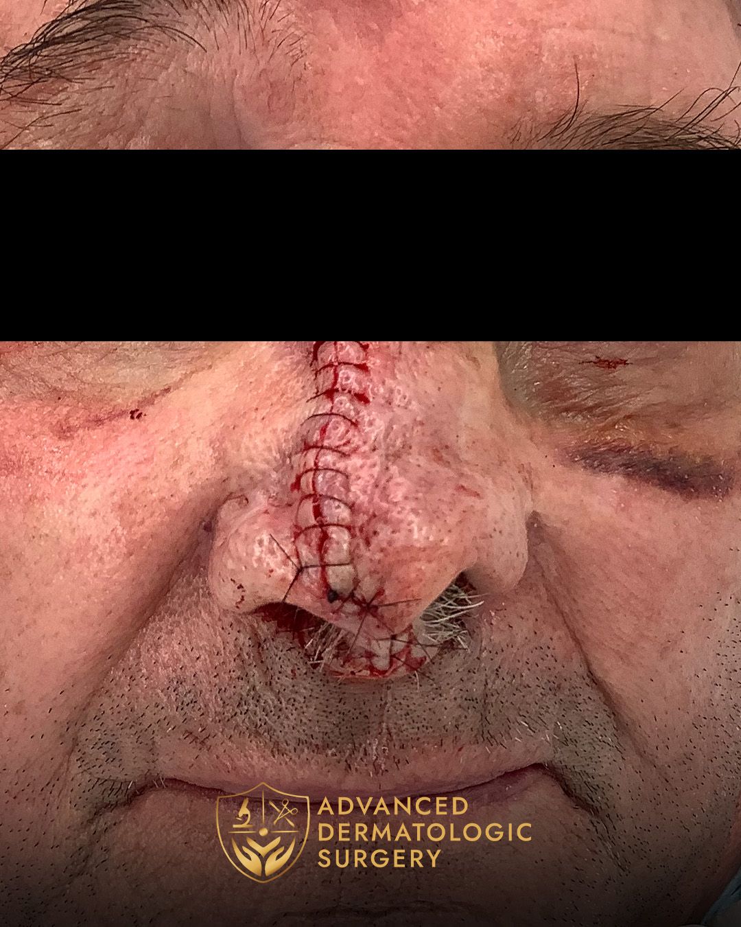 Close up of a man's nose after reconstruction surgery