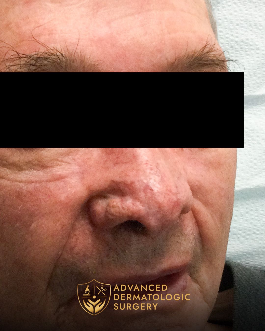 Close up of a man's nose after healing from surgery