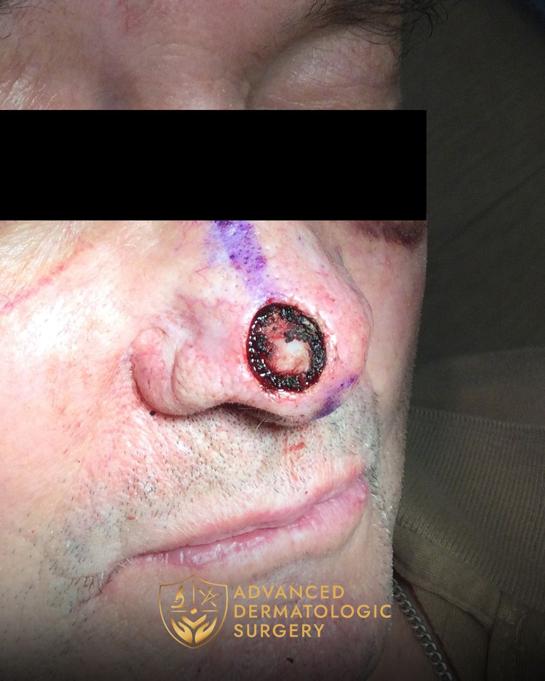 Close up of a man's nose after Mohs surgery