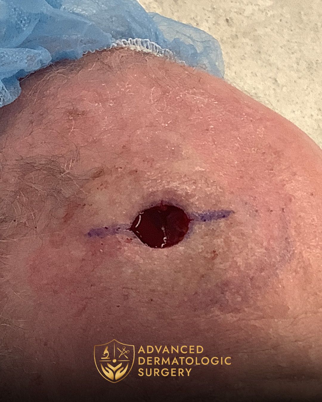 Close up of a Mohs surgery on a forehead