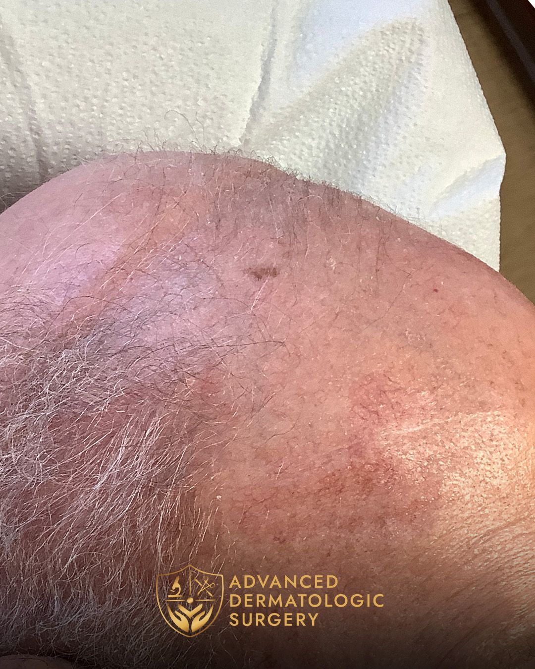 Close up of a fully healed forehead after sugery