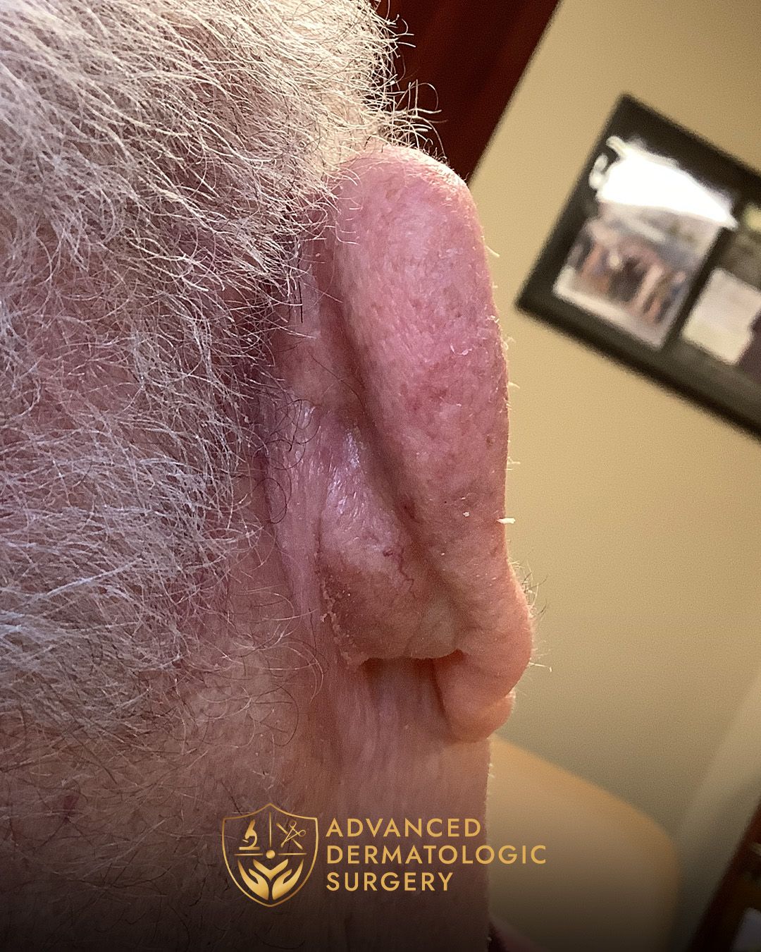 Close up of a man's fully healed ear