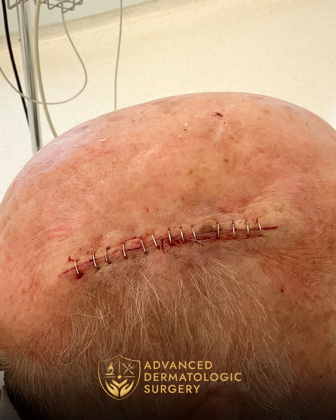 Long-term results of Mohs and reconstructive surgery at Advanced Dermatologic Surgery.