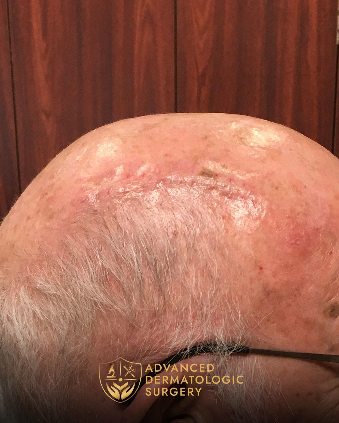 Long-term results of Mohs and Reconstructive Surgery at Advanced Dermatologic Surgery.
