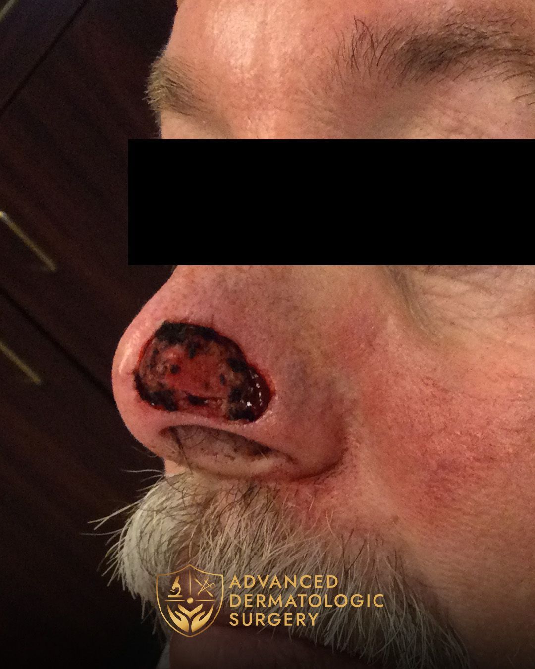 Close up of a man's nose after receiving mohs surgery