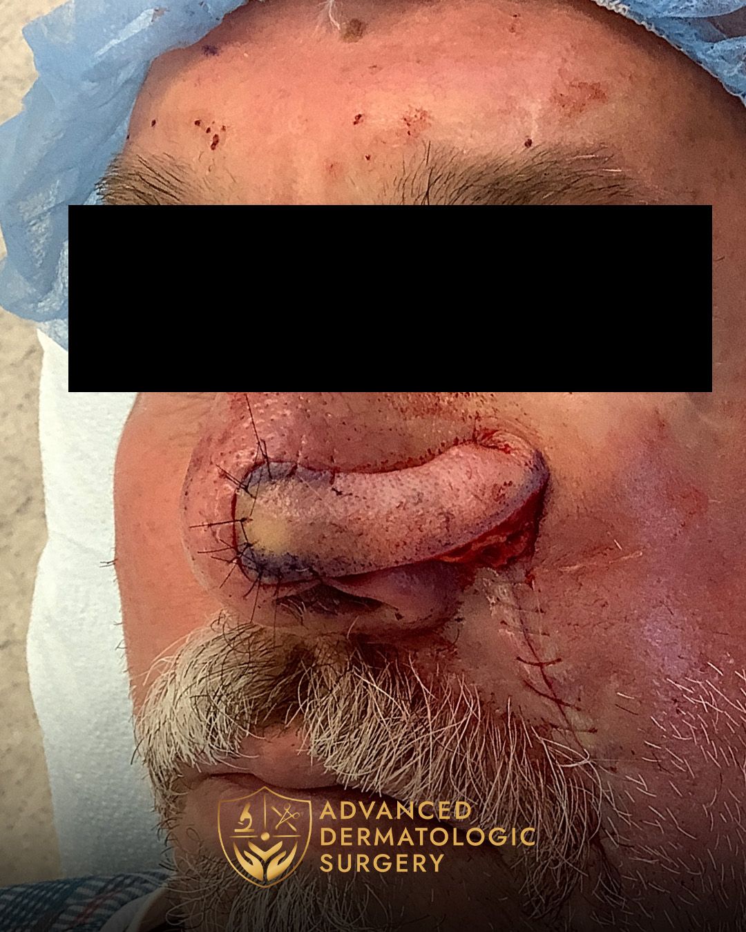 Close up of a man's nose after reconstruction surgery
