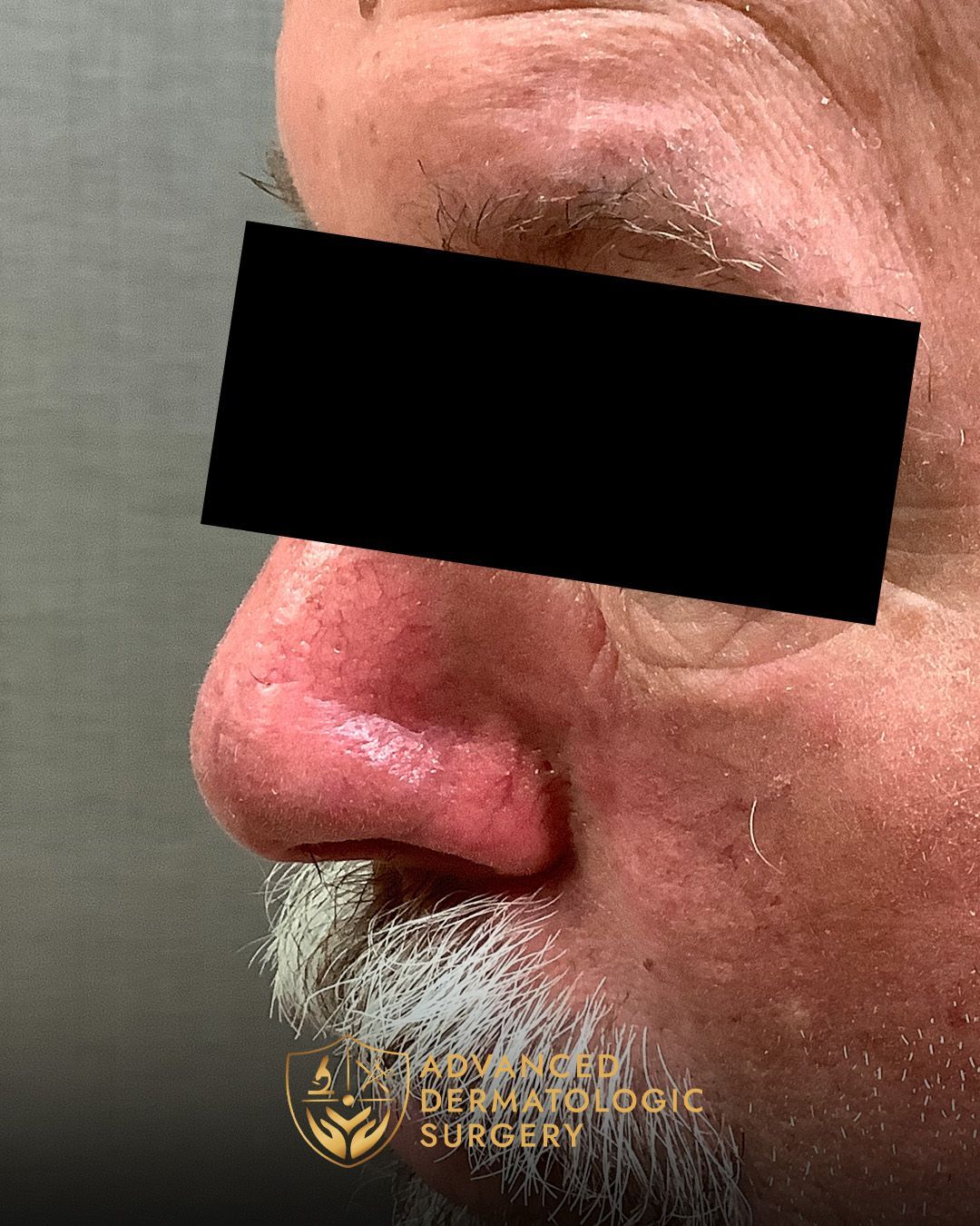 Close up of a fully healed nose