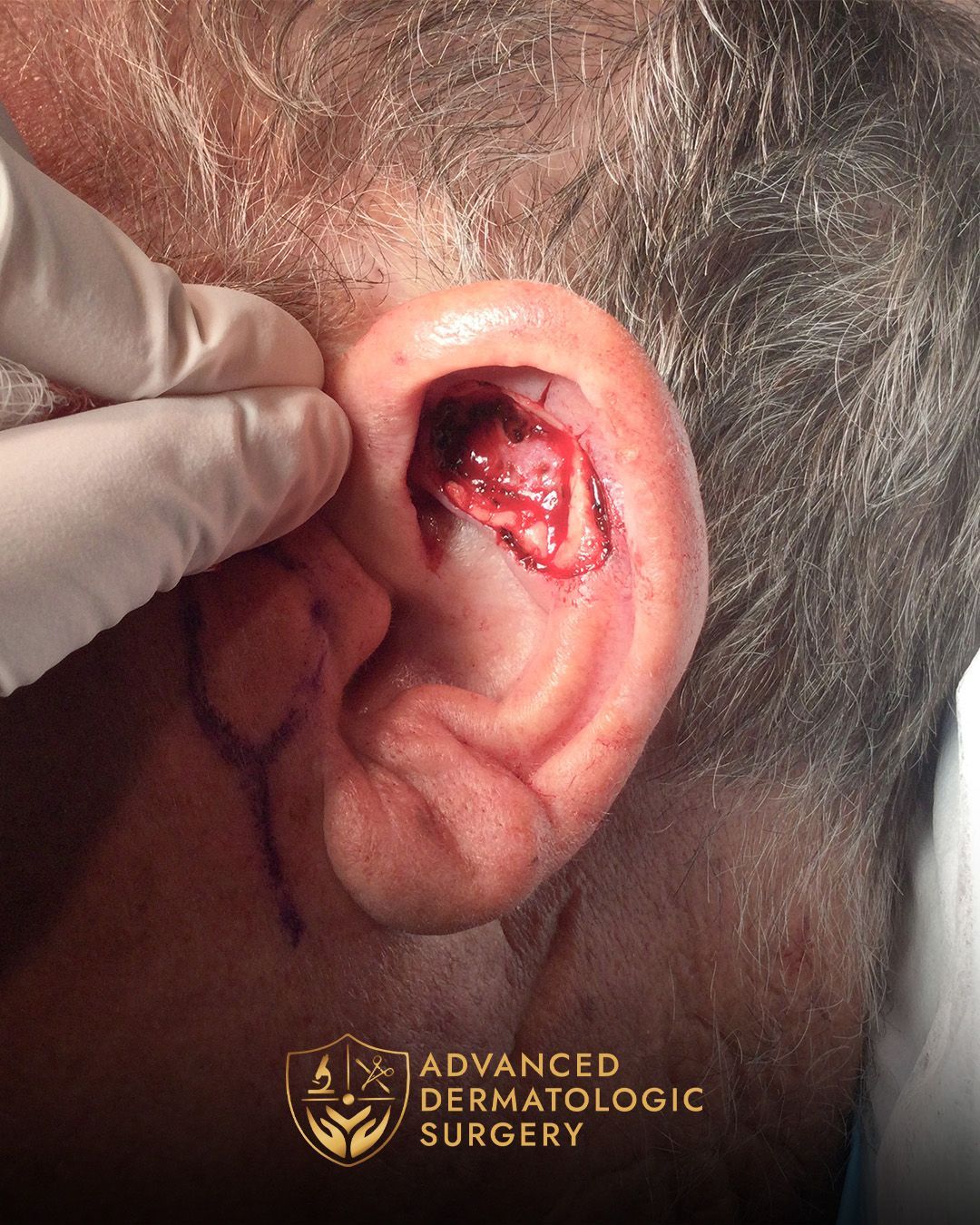 Close up of ear after Mohs surgery