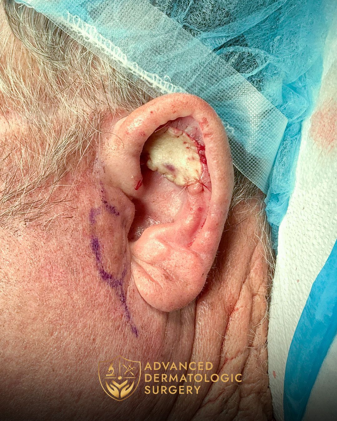 Close up of ear after reconstruction surgery