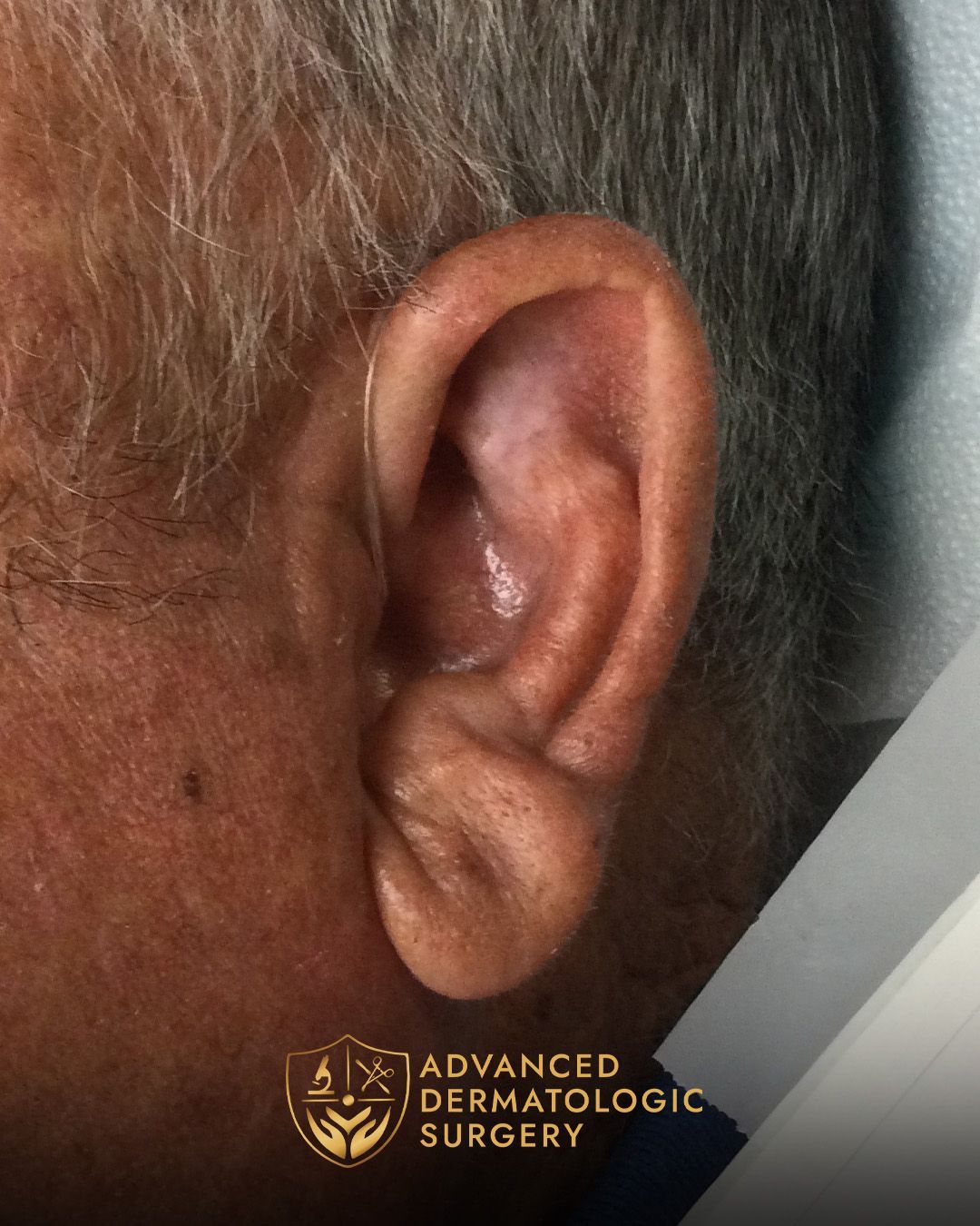 Close up of fully healed ear after surgery