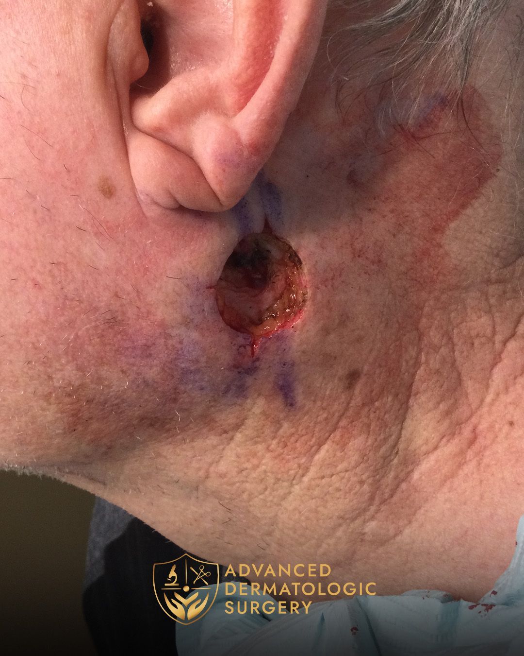 Close up of a man's neck after receiving Mohs surgery