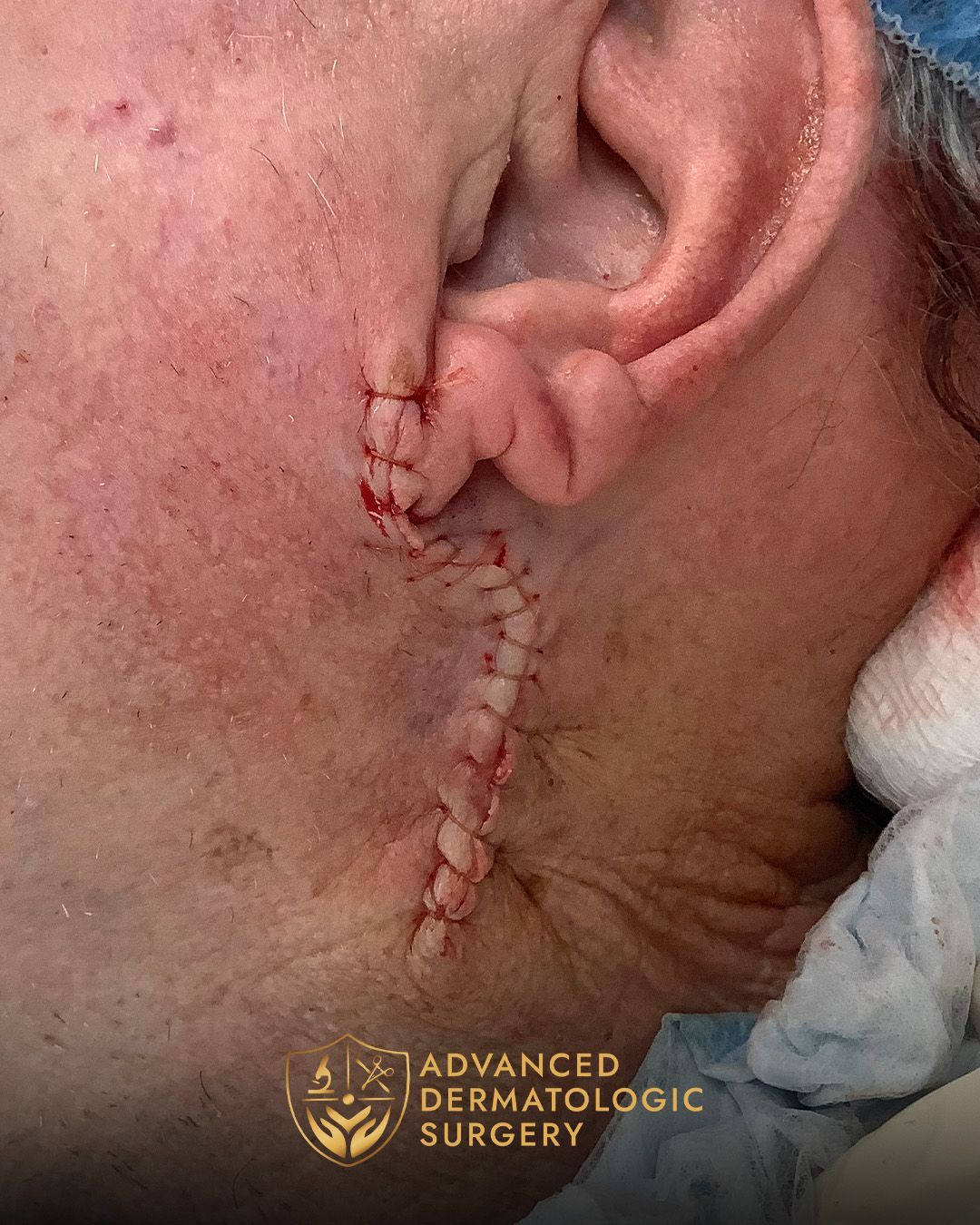 Close up of a man's neck after reconstructive surgery