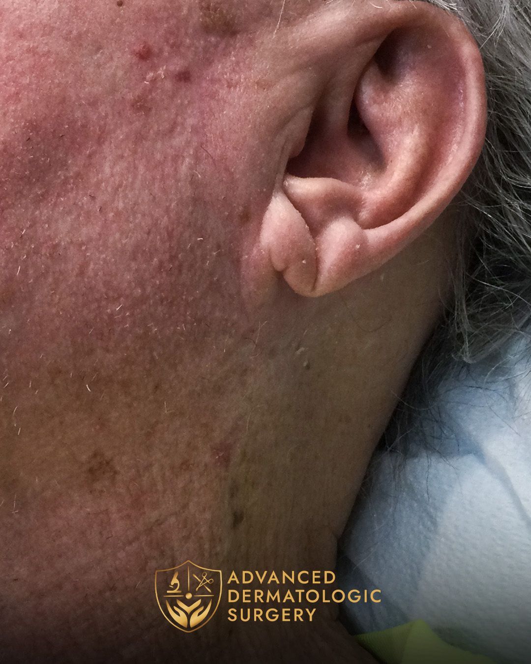 Close up of a fully healed neck after surgery
