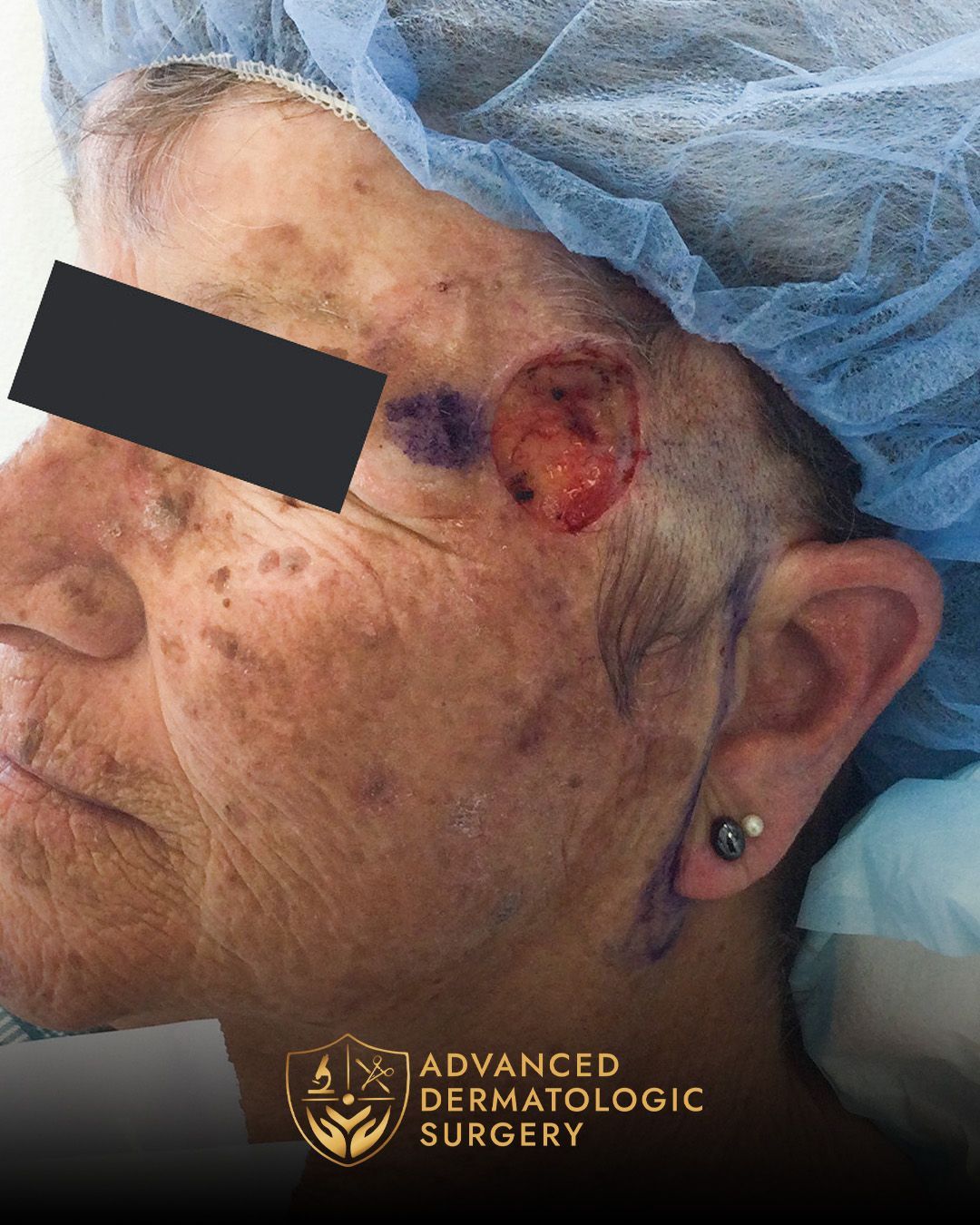 Close up of a pre operative surgery on a person's temple for Mohs surgery at Advanced Dermatologic Surgery