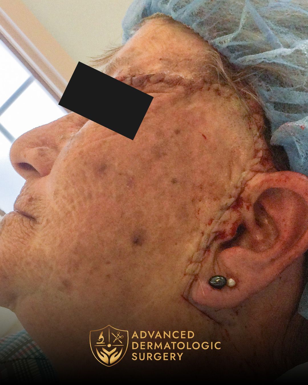 Side profile of a person with facial sun damage and dark spots, wearing a blue surgical cap in a clinic setting
