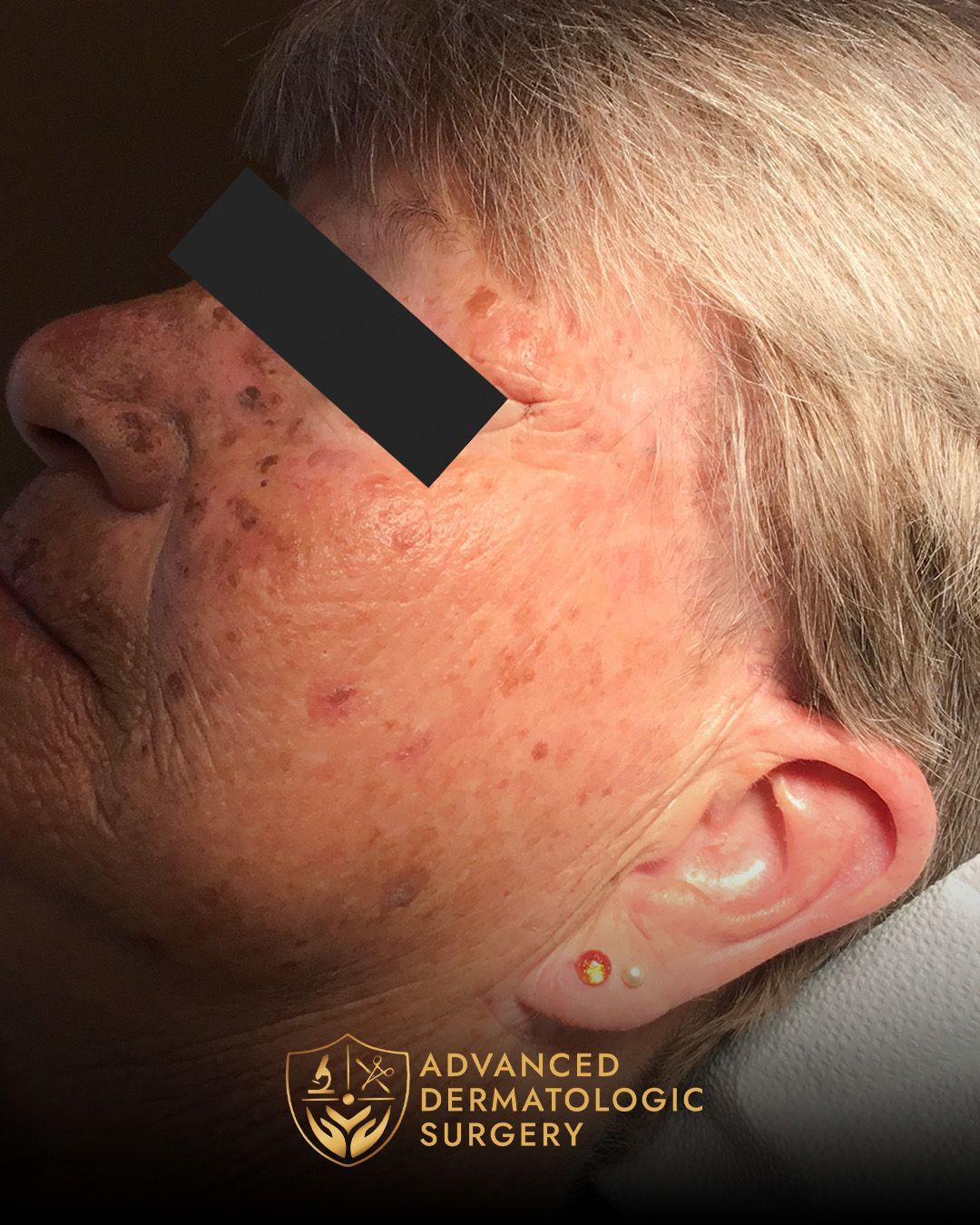 Close-up of a woman’s cheek and temple with multiple red acne-like spots and a black bar over the eyes.
