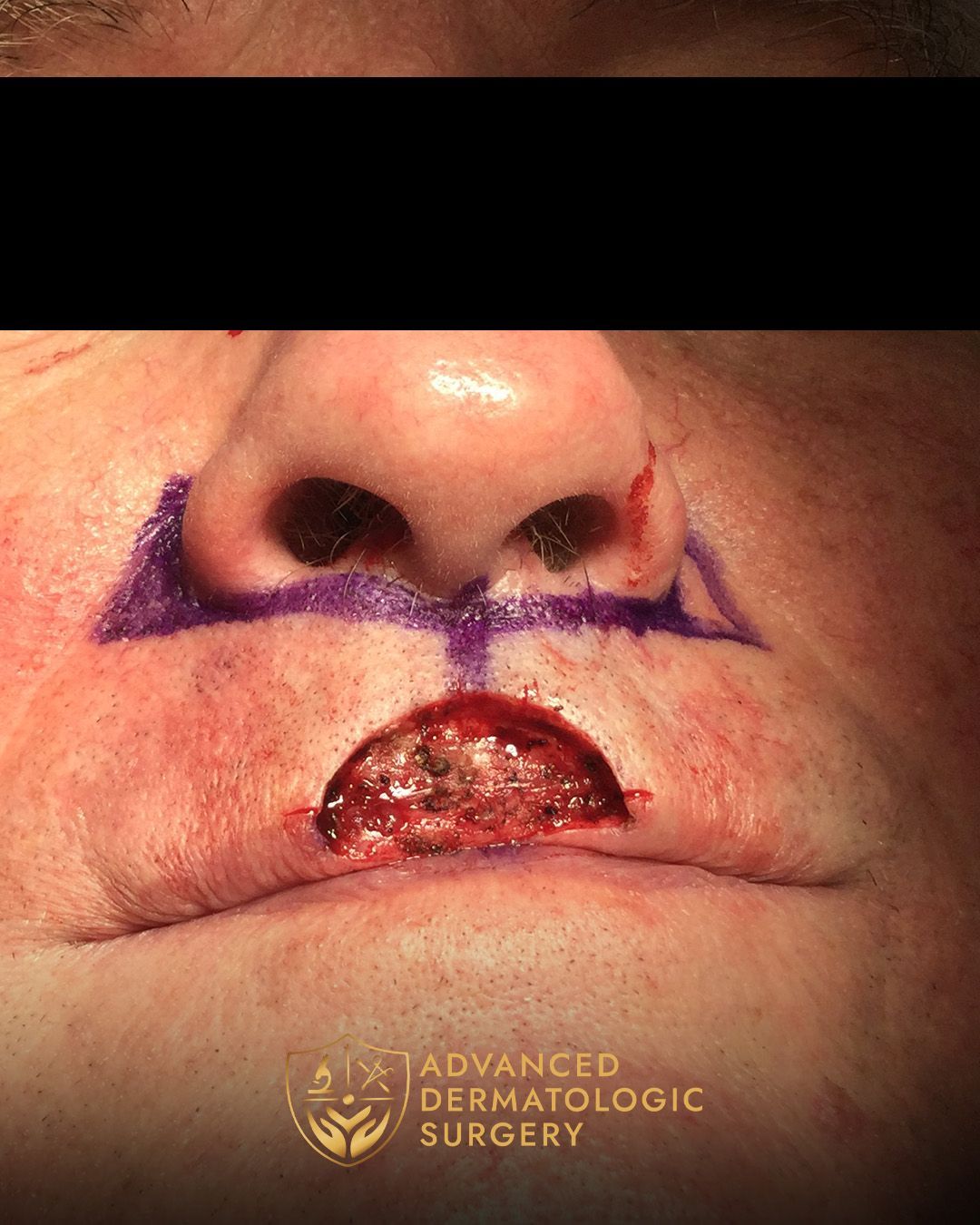 Close up of a post mohs surgery on a man's lip