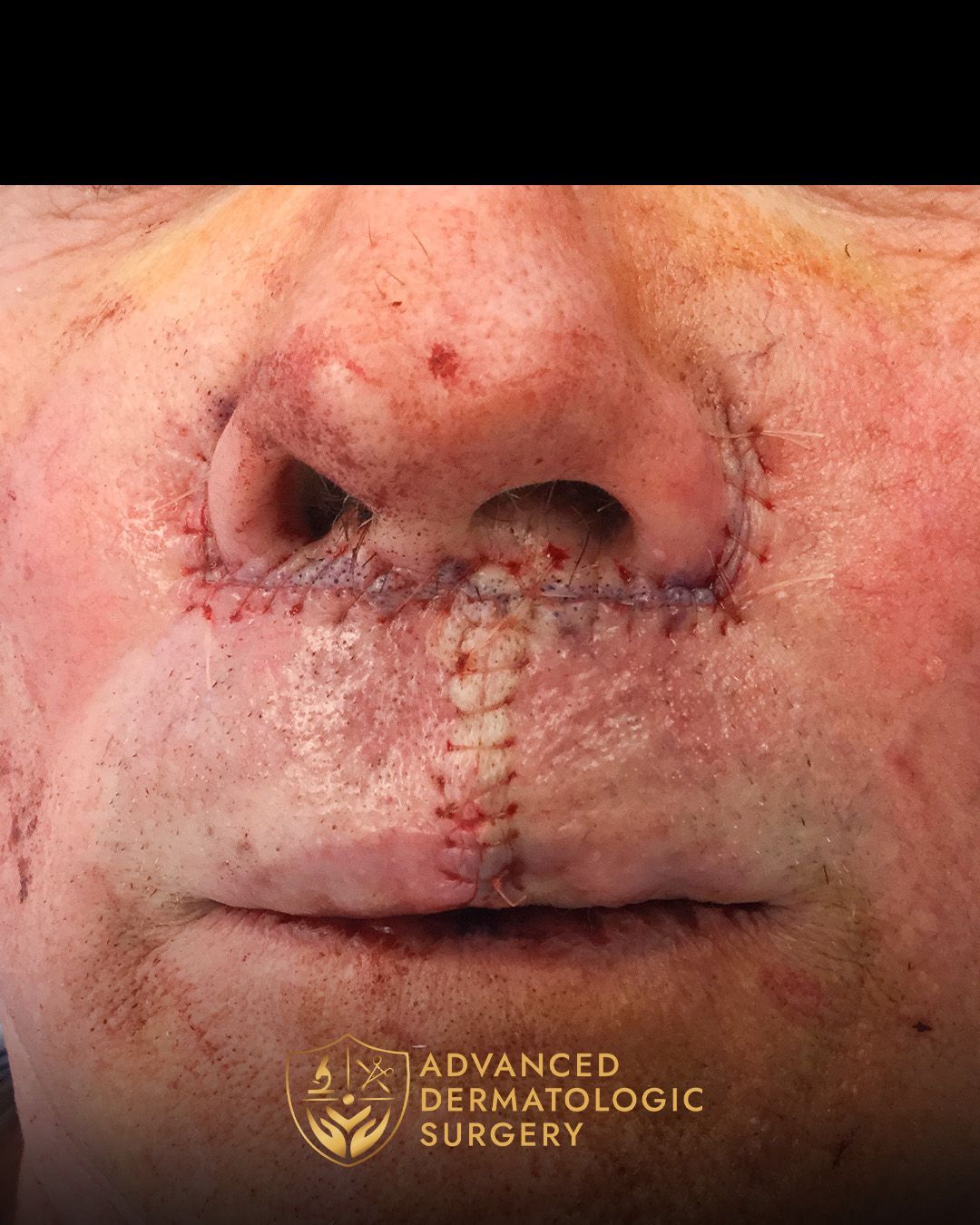 Close up of a man's lip after reconstruction surgery