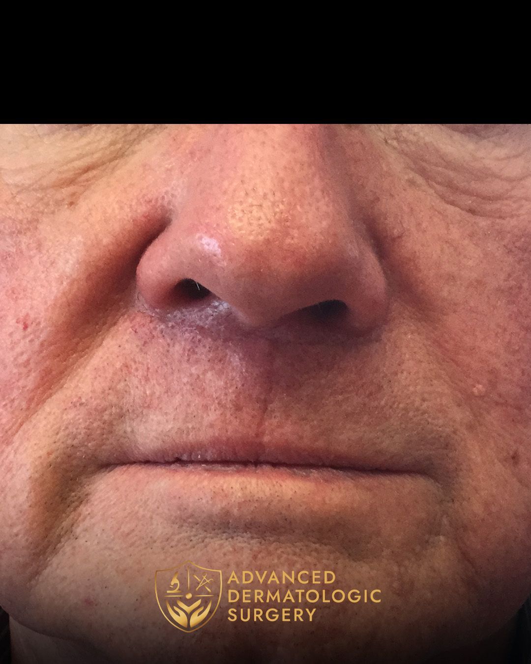 Close up of a man's healed lip after surgery