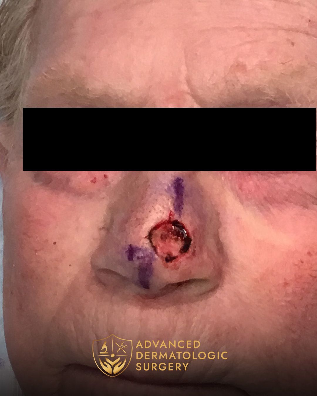 Mohs surgery of the nose at Advanded Dermatologic Surgery 