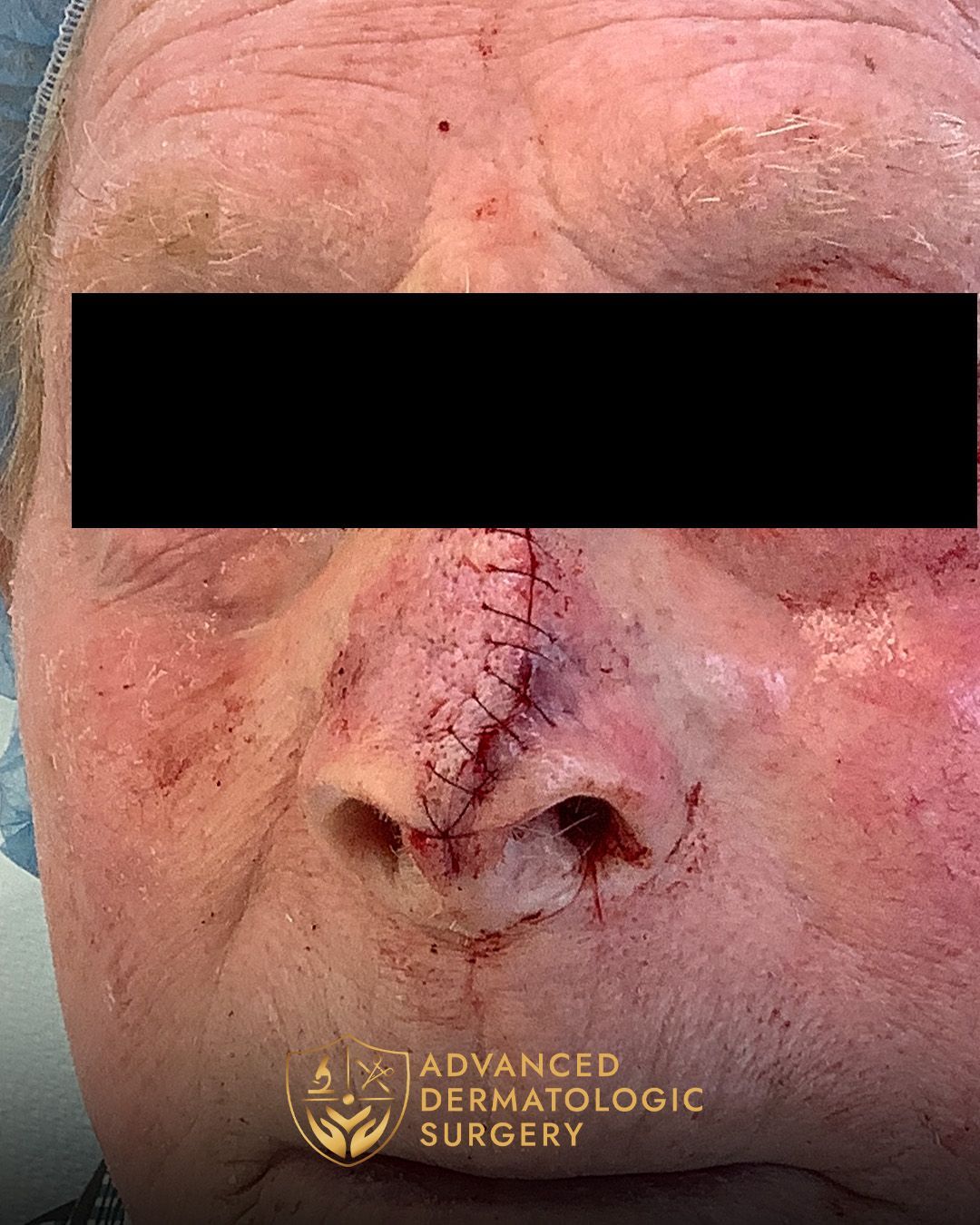 Reconstructive surgery on the nose after Mohs surgery at Advanded Dermatologic Surgery 