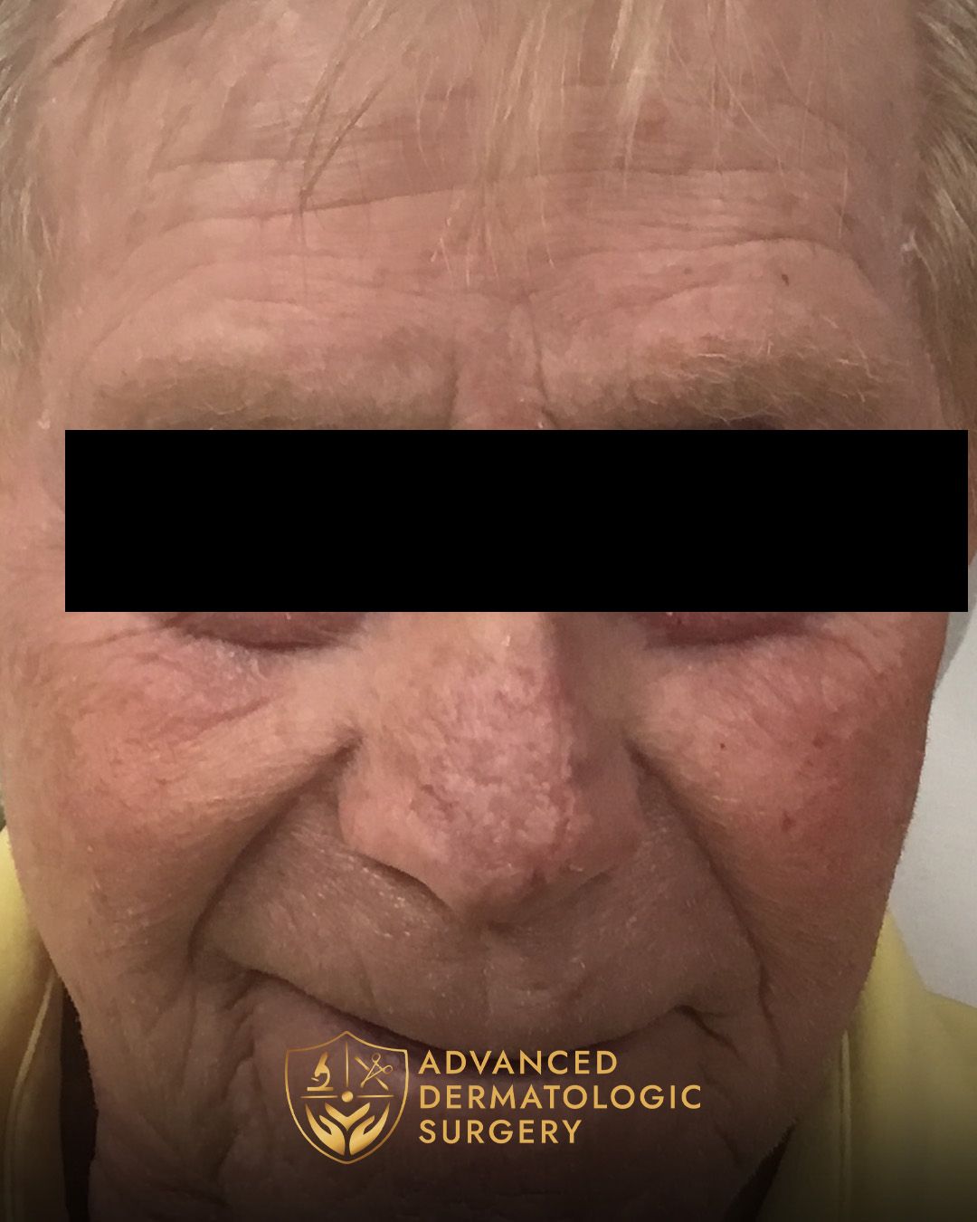 Long-term results of Reconstructive and Mohs surgery at Advanded Dermatologic Surgery 
