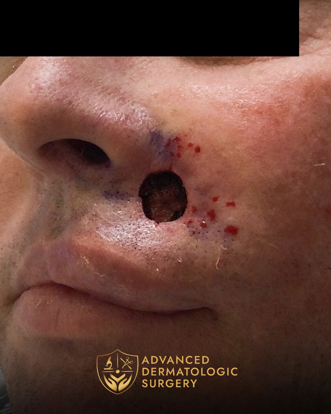 Close up of a post mohs surgery on a mans cheek