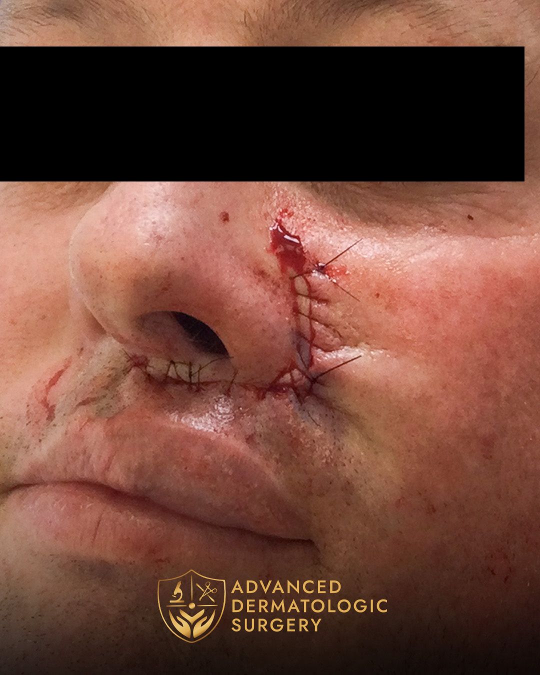 Close up of a man's cheek after reconstruction surgery