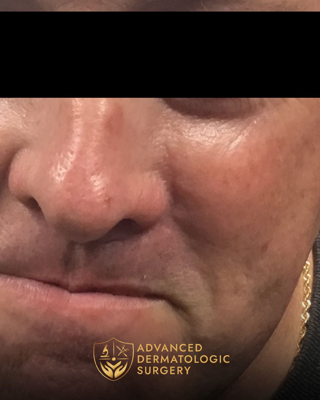 Close up of a man's healed cheek