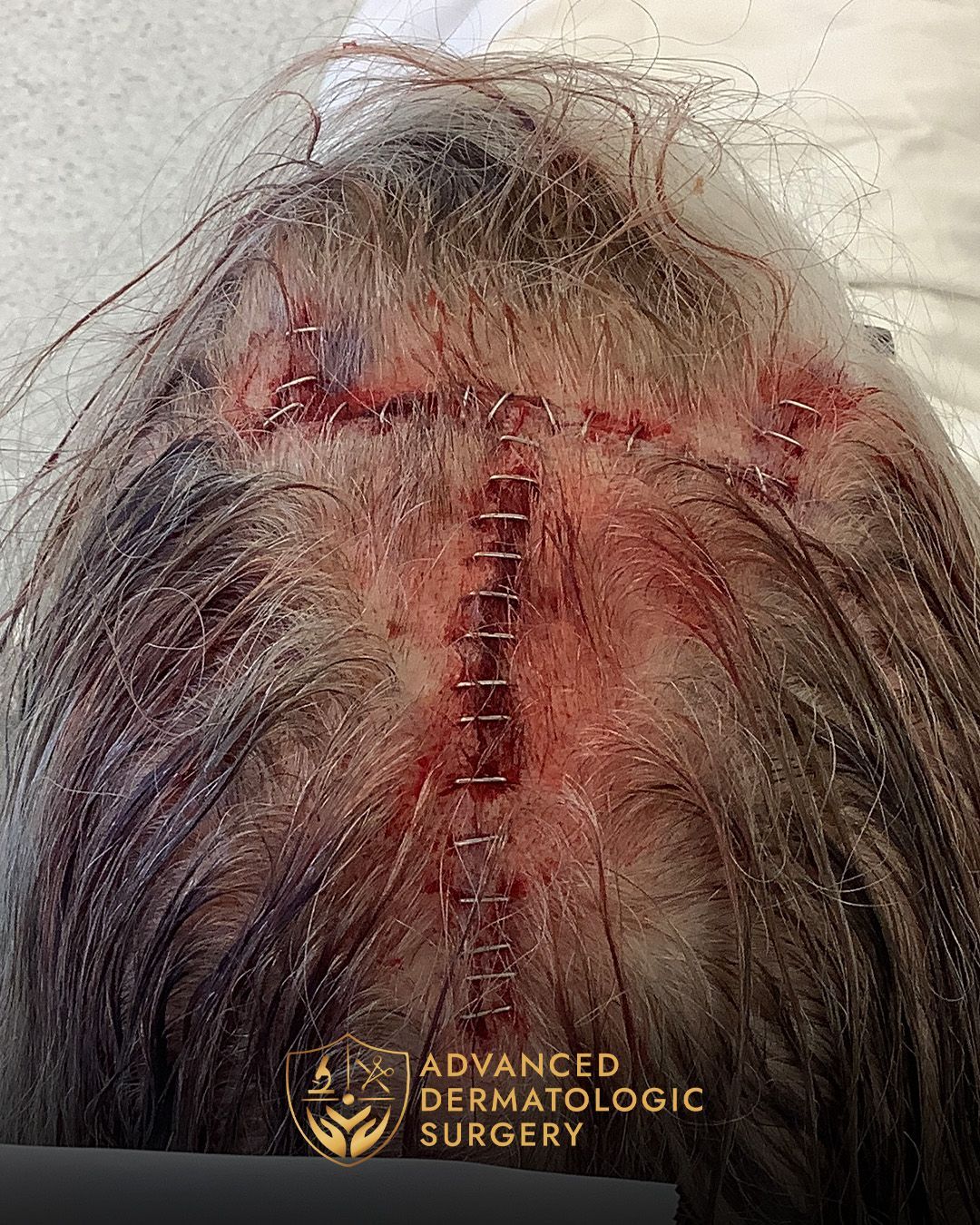Close up of a reconstruction surgery on a scalp