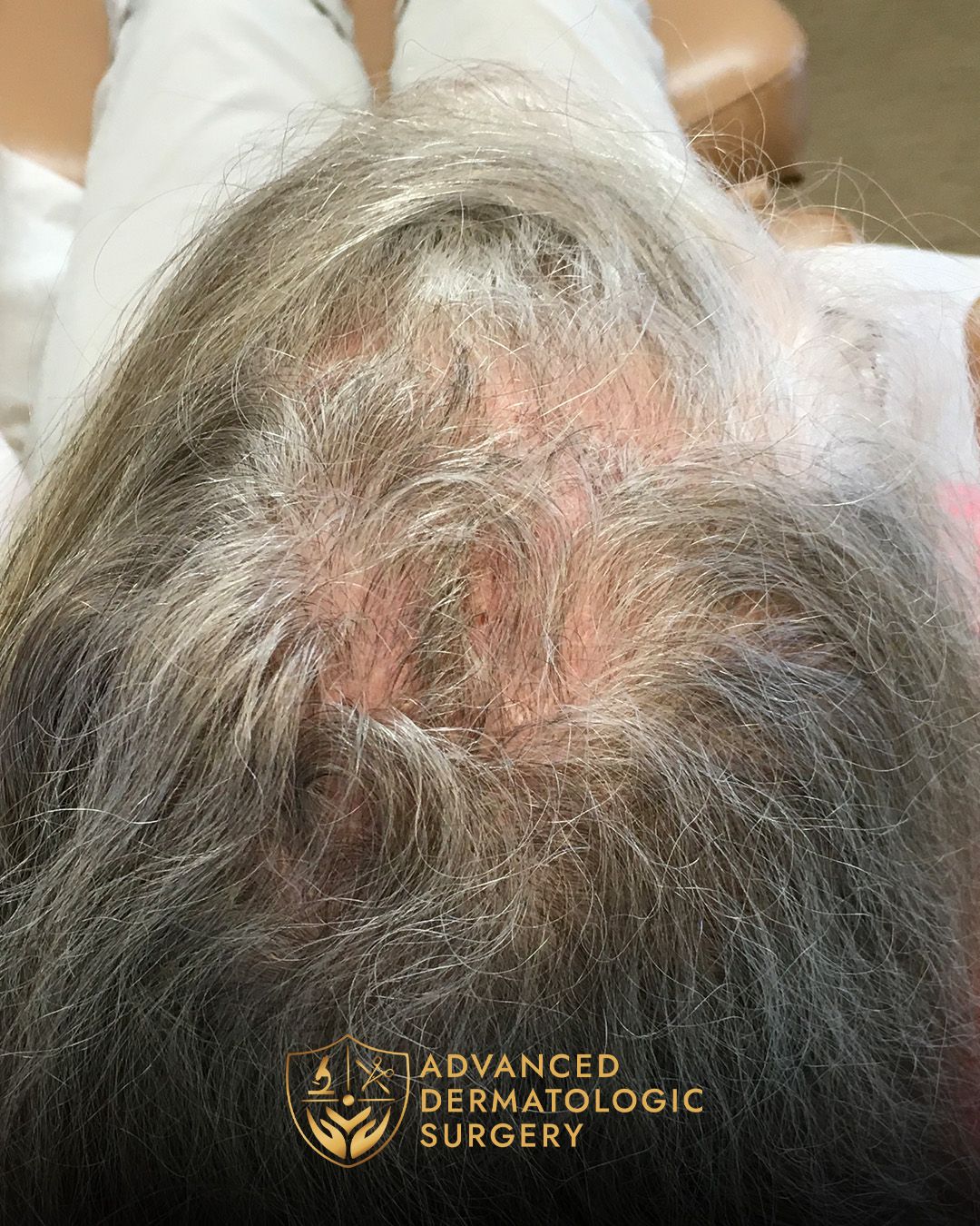 Close up of a fully healed scalp