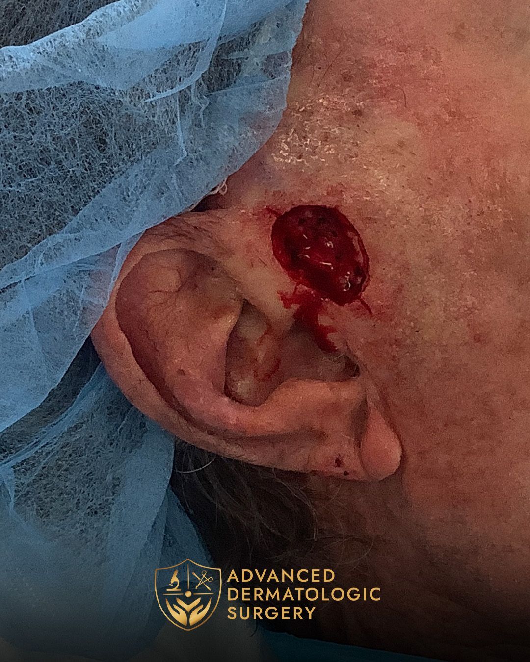 Close up of a spot removal by a man's ear