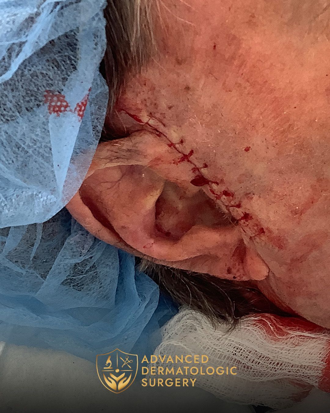 Close up of a man's ear after reconstruction surgery