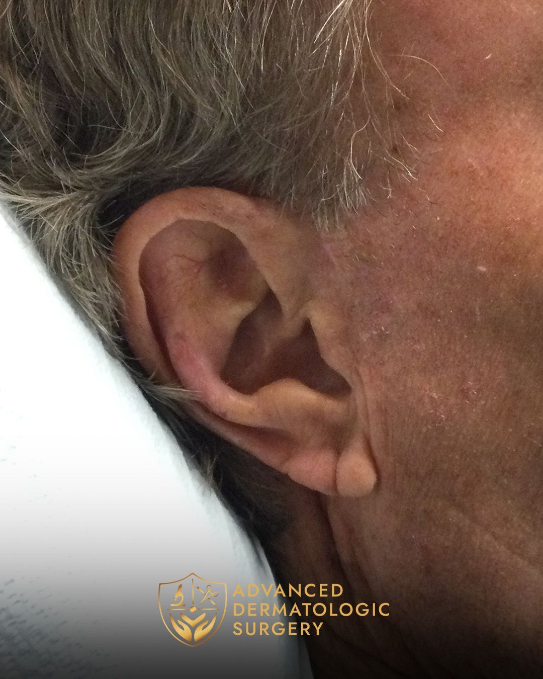 Close up of a man's ear after healing