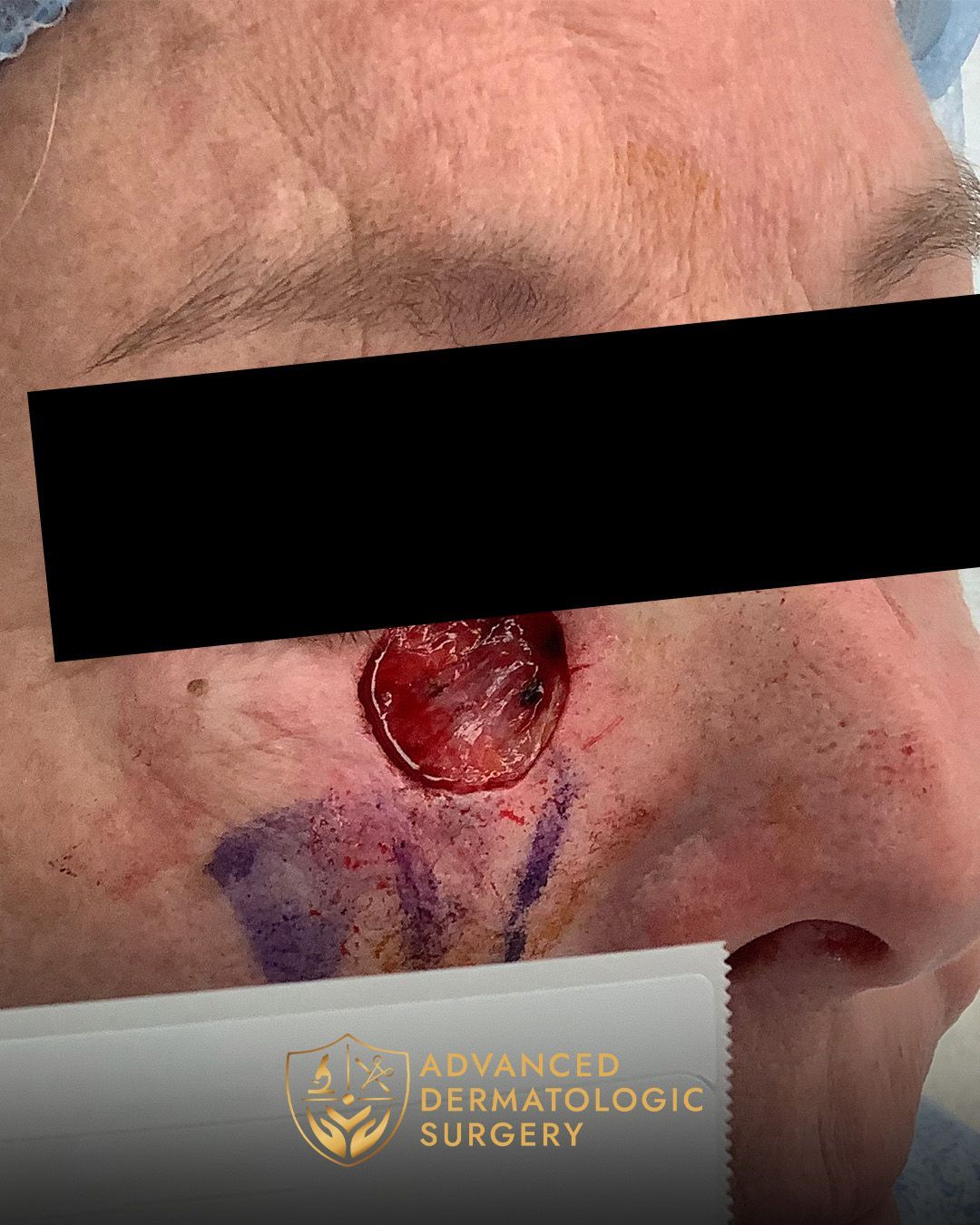 Close up of a womans cheek who had Mohs surgey