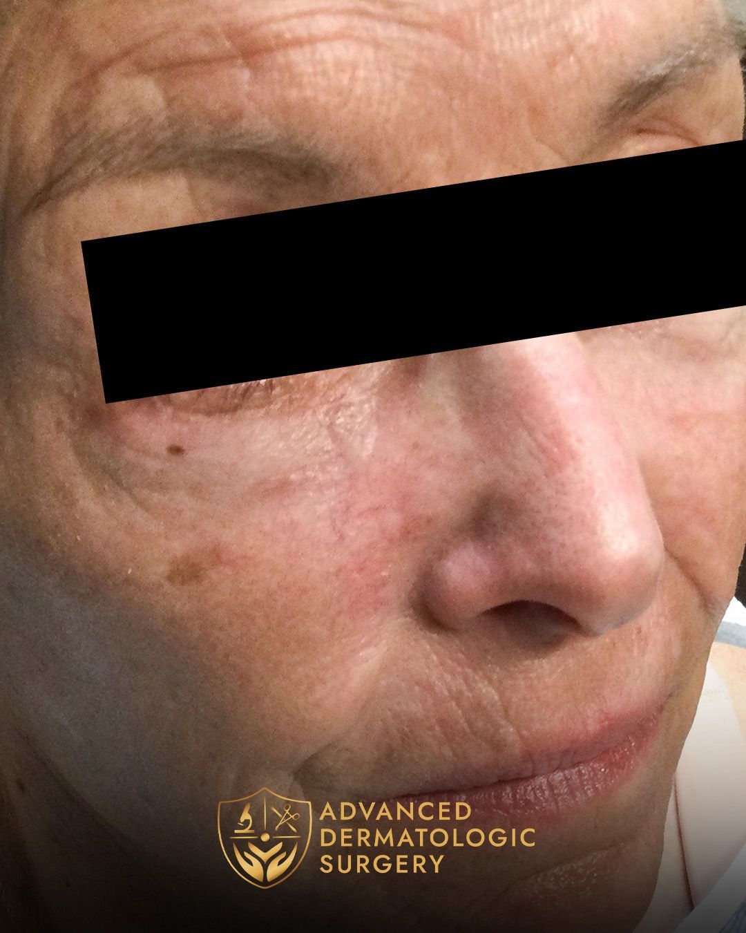 Close up of a fully healed woman's cheek after surgery