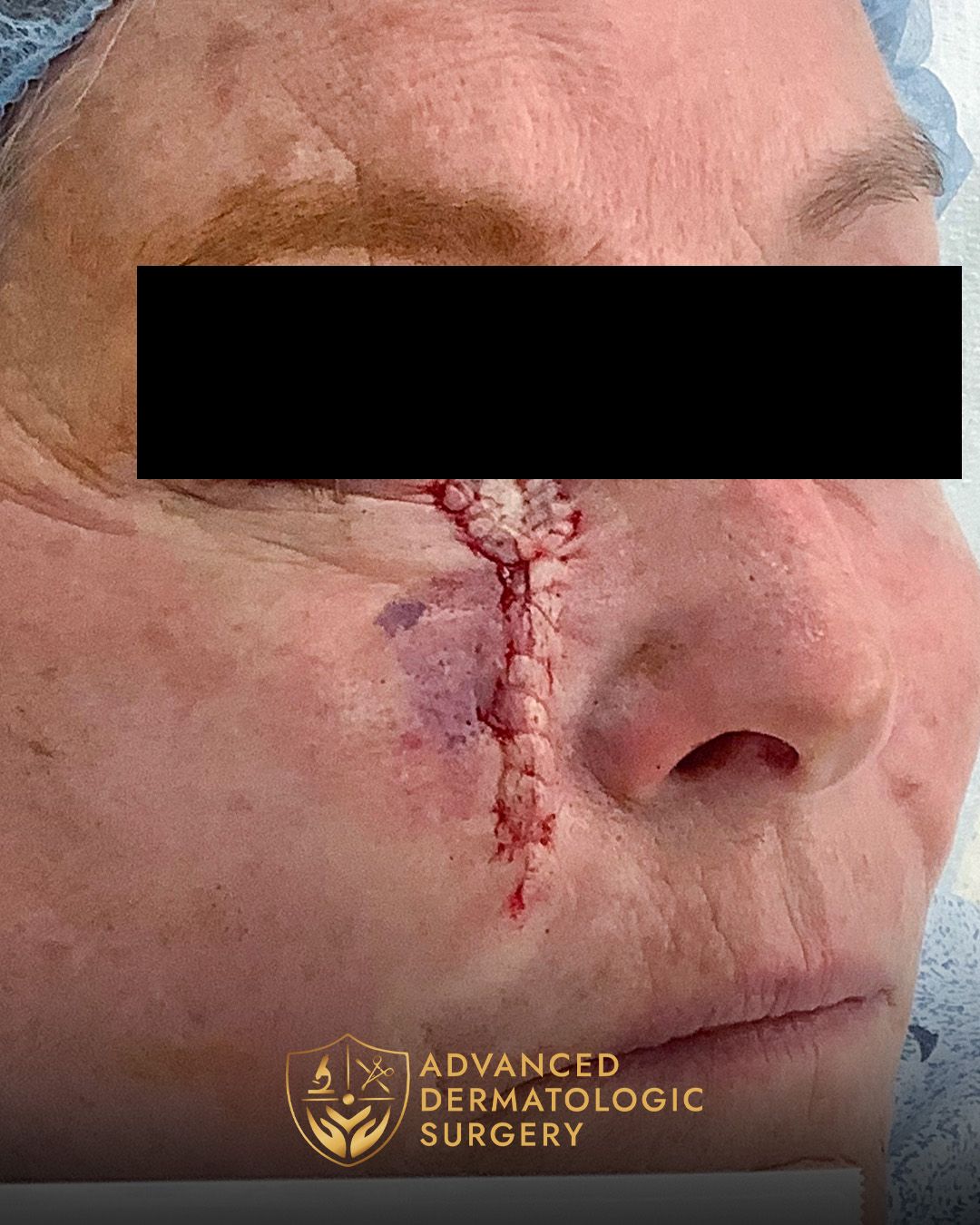 Close up of a woman's cheek after reconstruction surgery