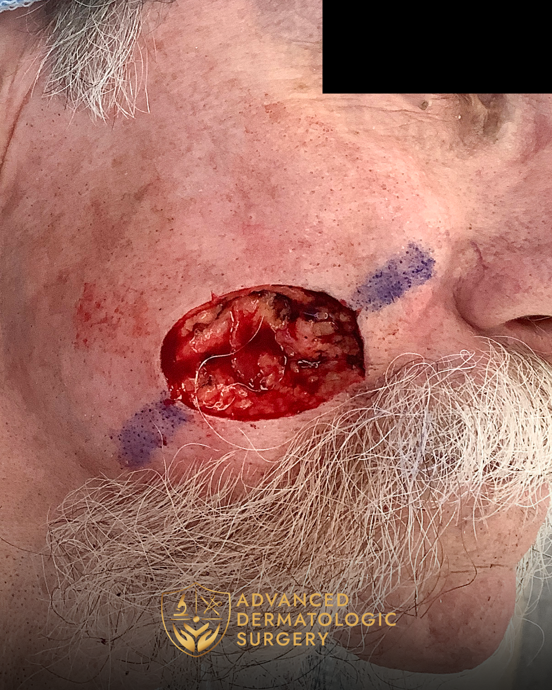 Close up of a post mohs surgery on a mans cheek