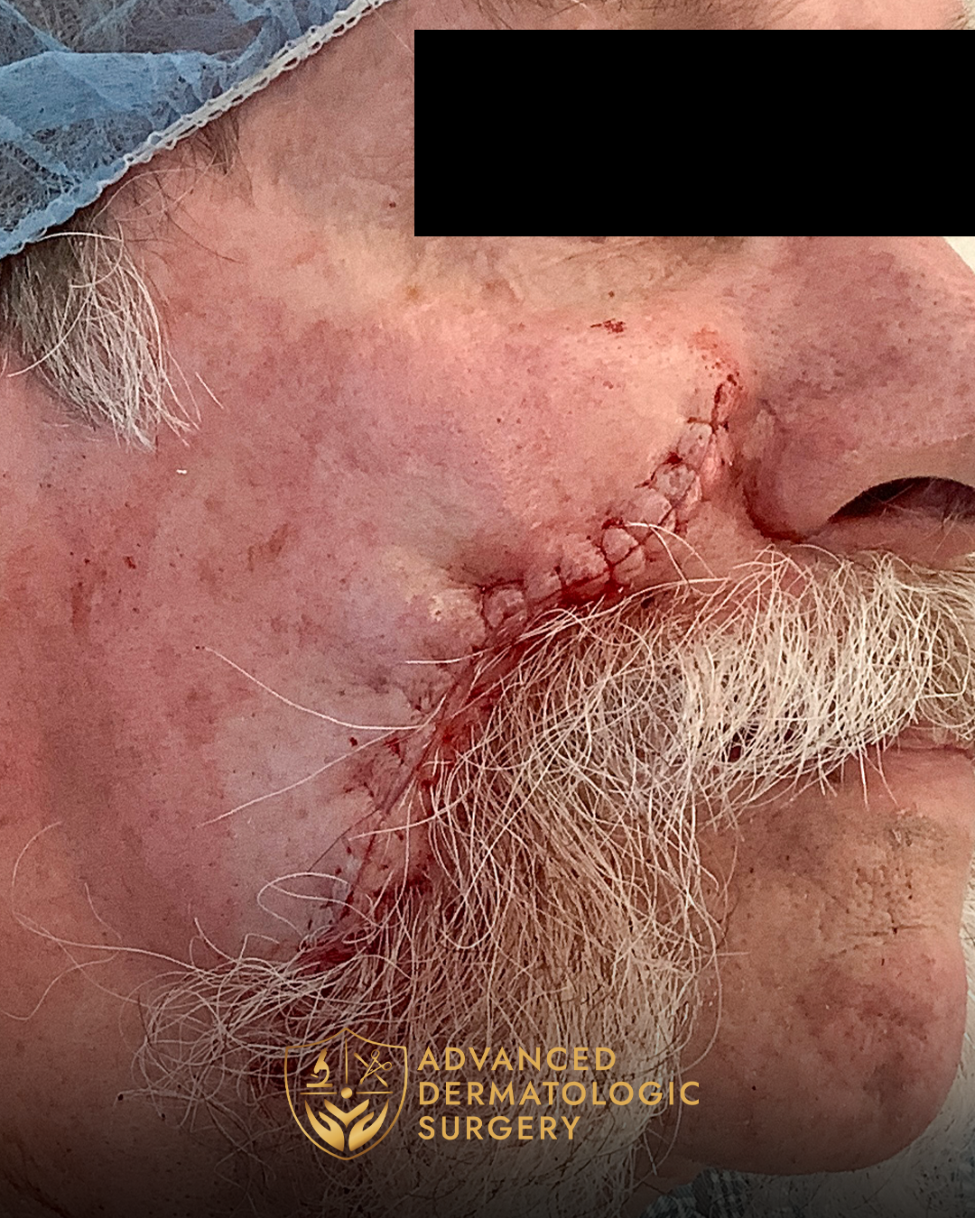 Close up of a man's cheek after reconstruction surgery