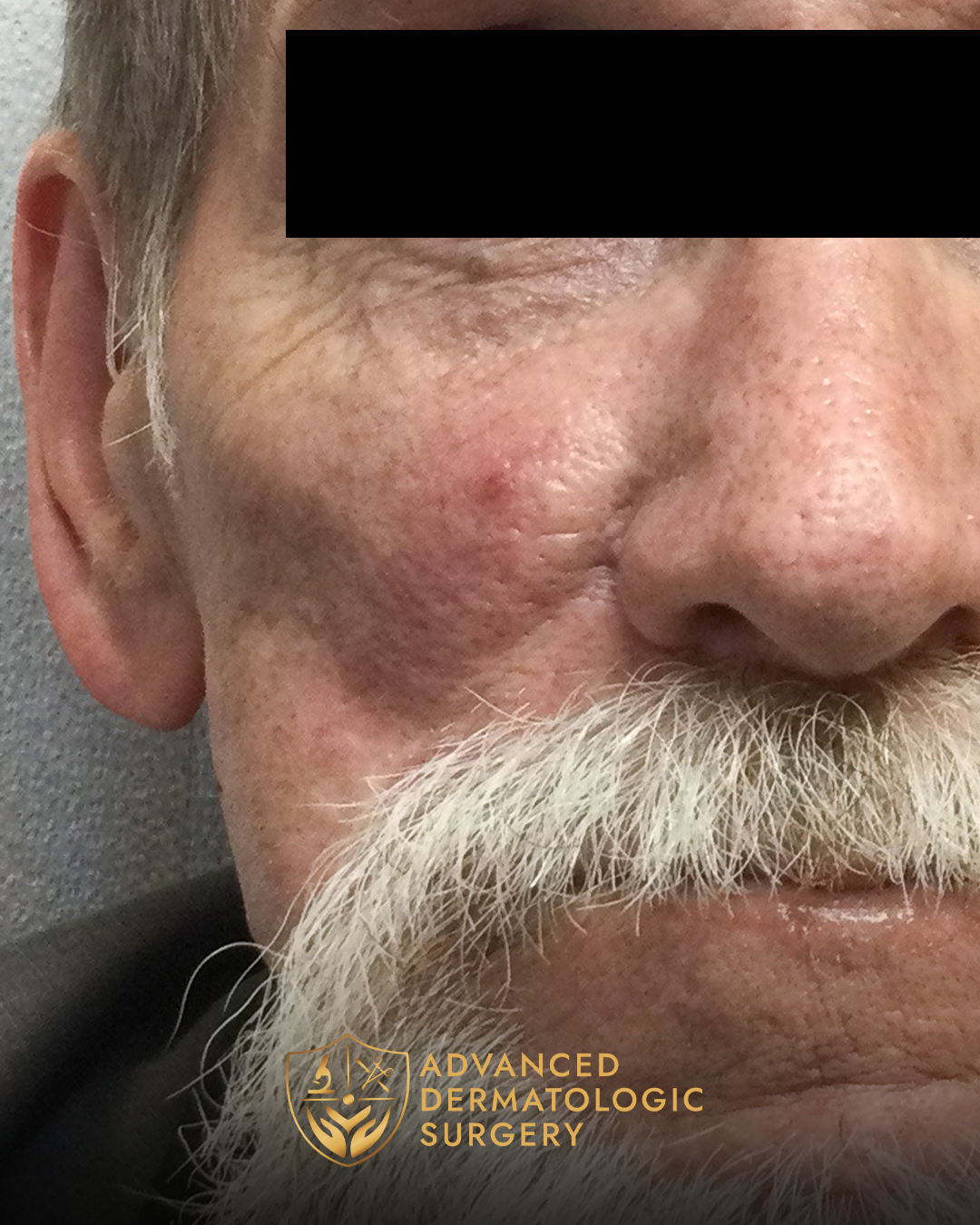 Close up of a man's healed cheek