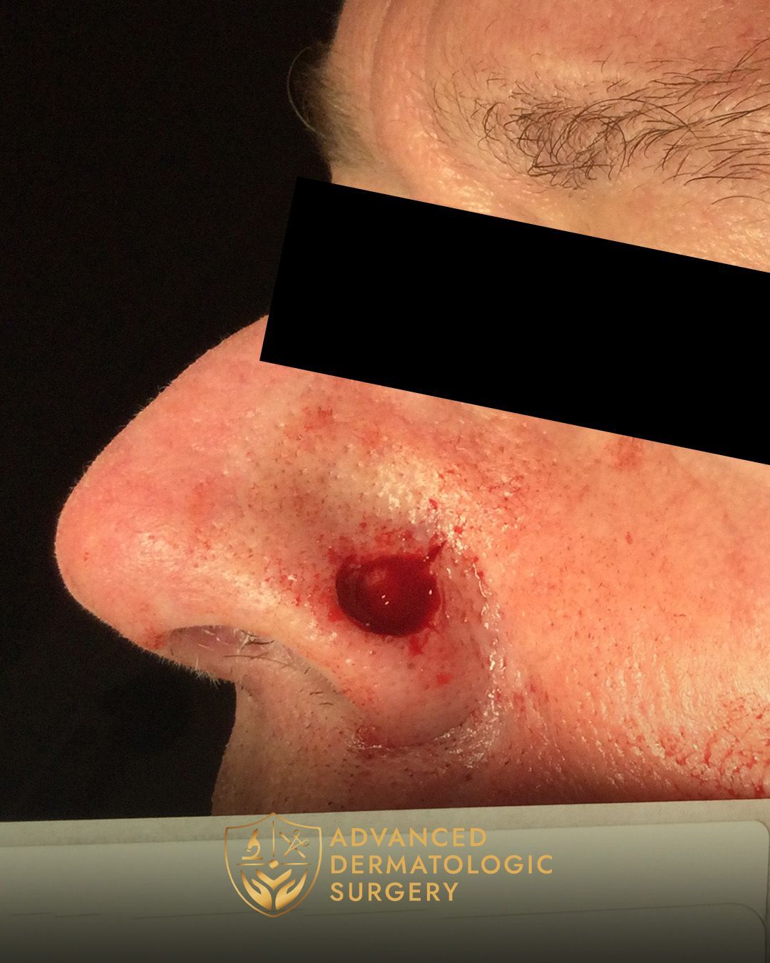 Close up of a man facing toward the left after MOHS surgery