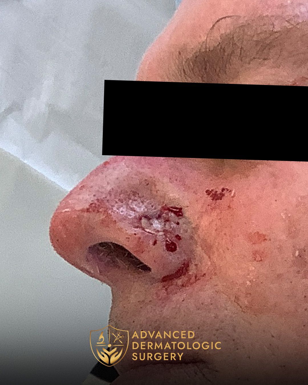 Close up of a man's nose facing toward the left
