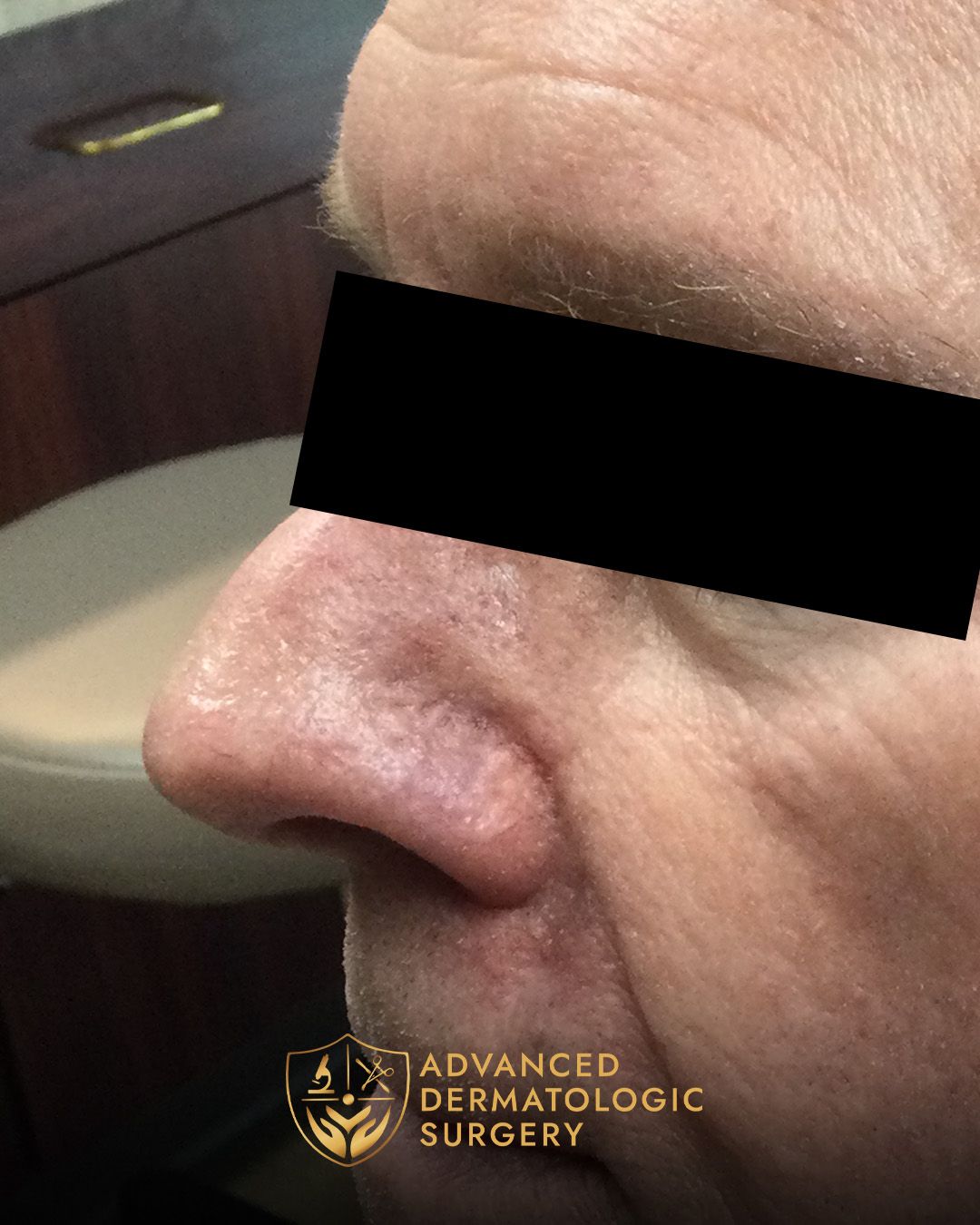 Close up of a man's healed nose 