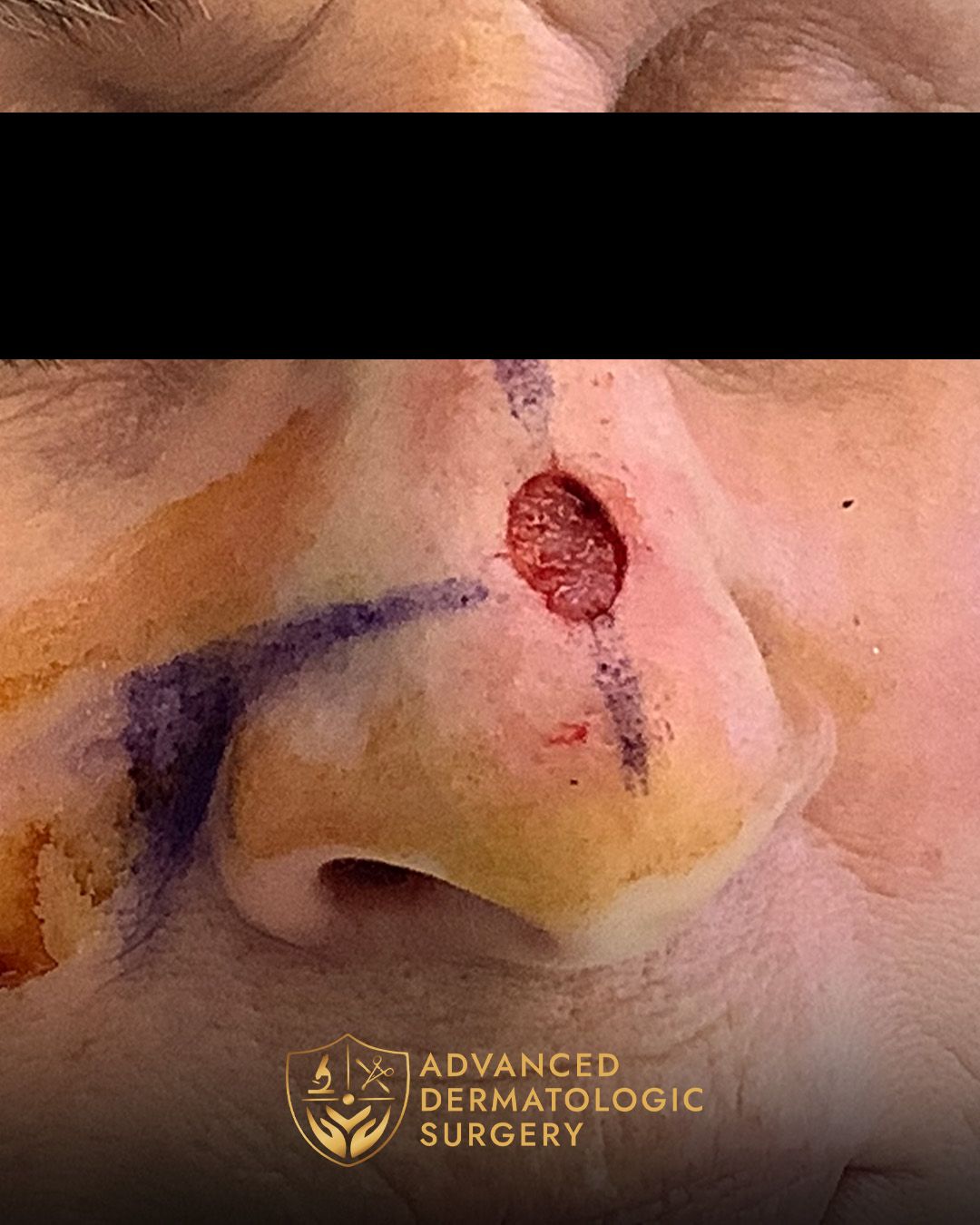 Close up of a woman's nose after MOHS